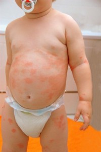 Екзема в дитини (атопічний дерматит) – причини, симптоми та методи лікування