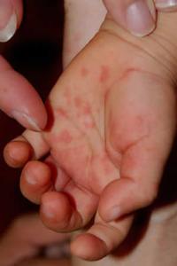 Ентеровірусна інфекція в дітей