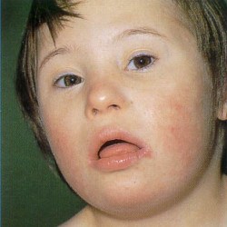 Синдром Дауна в дітей – симптоми та прогноз
